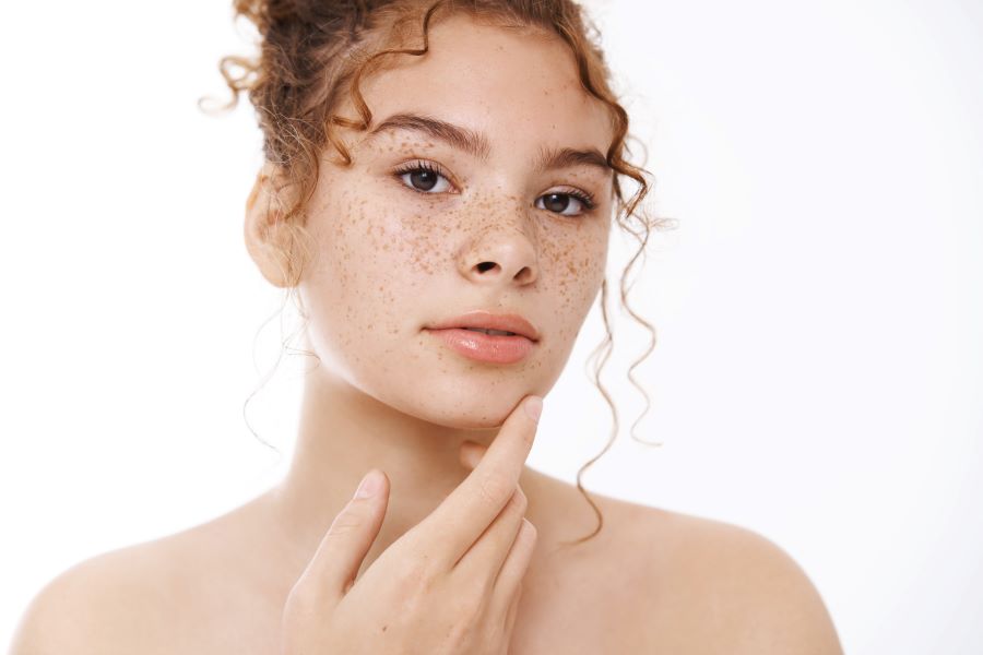 Acne grave: i prodotti per curarla