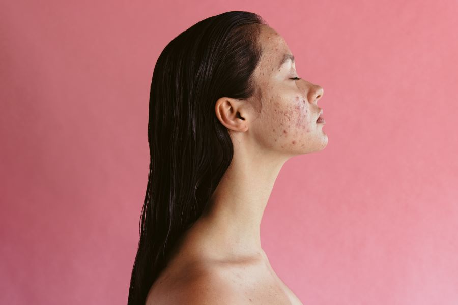 Acne giovanile: l'età e le cause