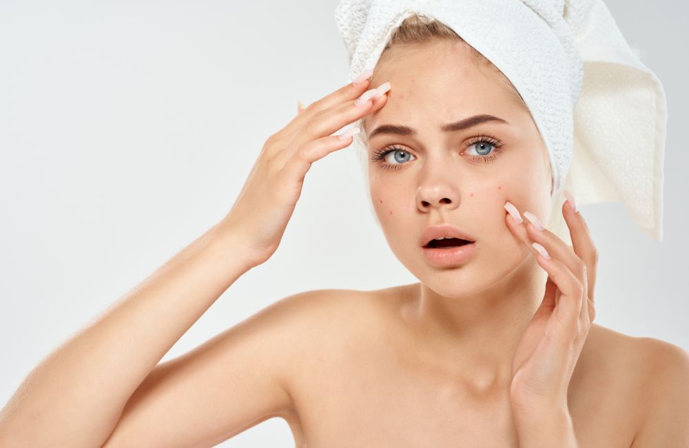 Crema per acne: dì addio ai brufoli!